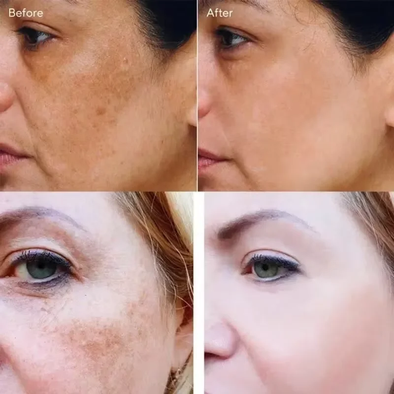 Vitamin C Whitening Freckles Face Cream Remove Melasma Dark Spots Lighten Melanin Acne Scar Anti-aging Brighten Face Skin Care