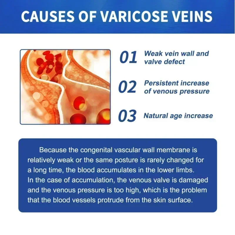 ใหม่เส้นเลือดขอดซ่อม Tongmai ที่มีประสิทธิภาพบรรเทาขา Bulge Pain Treatment Vasculitis Phlebitis ลบหลอดเลือดดํา 77