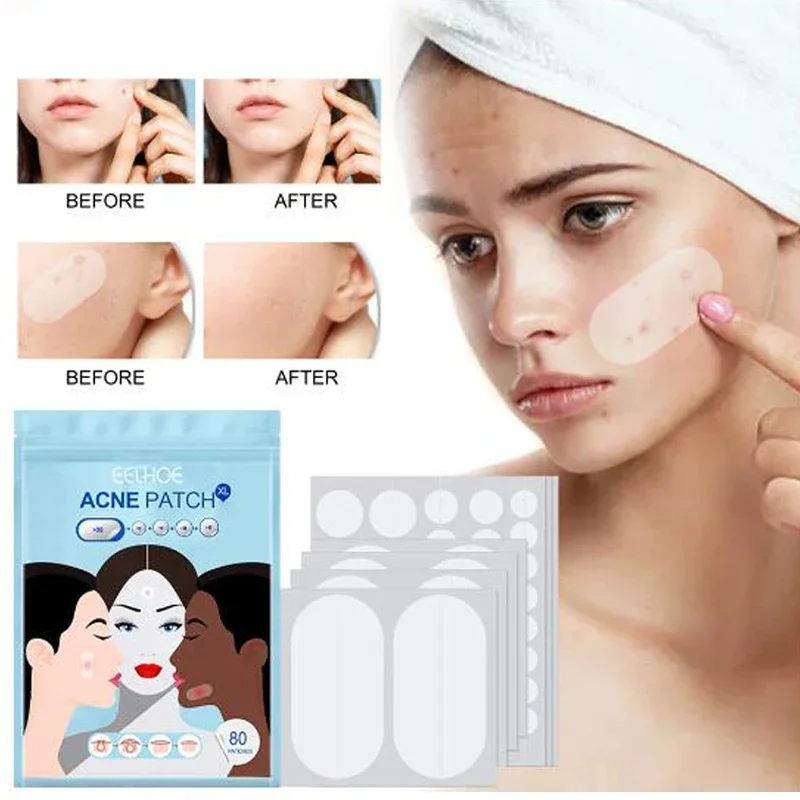 Atadura hidrocolóide para acne e cuidados com a pele, Removedor de manchas, cravo e Blemi Patch, 80 unidades por embalagem