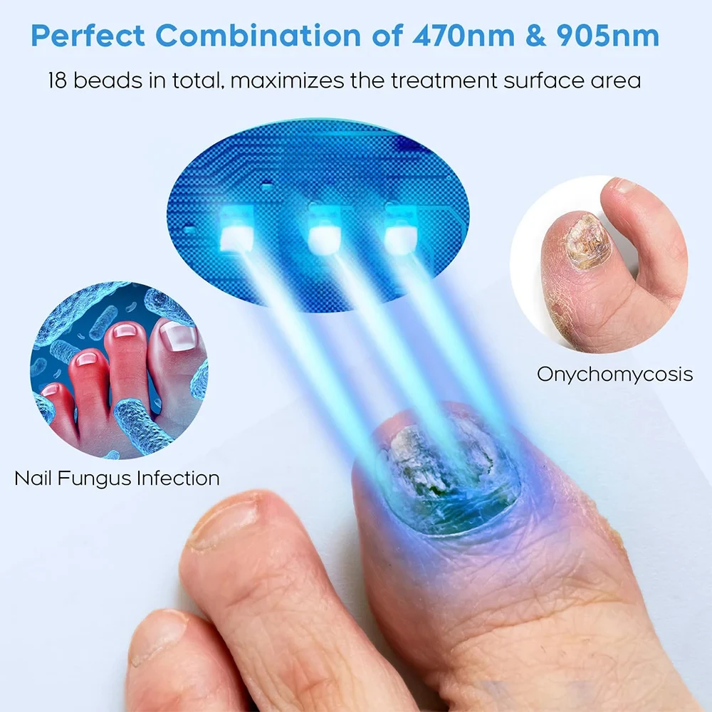 Appareil laser antifongique pour ongles incarnés, réparation rapide des champignons, onychomycose, ongle d'orteil, élimine les champignons des ongles, soin des pieds