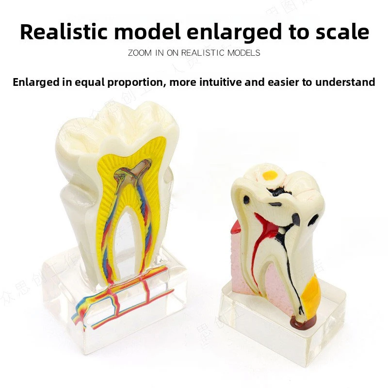 

Dental Oral Model Quadruple Comprehensive Pathological Model Six Fold Neural Breakdown Model Demonstration of dental pulp