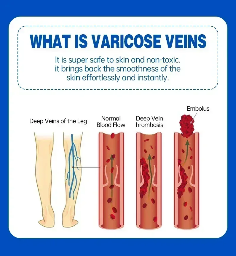 NewOintment untuk varises menghilangkan vaskulitis flebitis untuk meringankan nyeri kaki laba-laba pengobatan 0903 Herbal