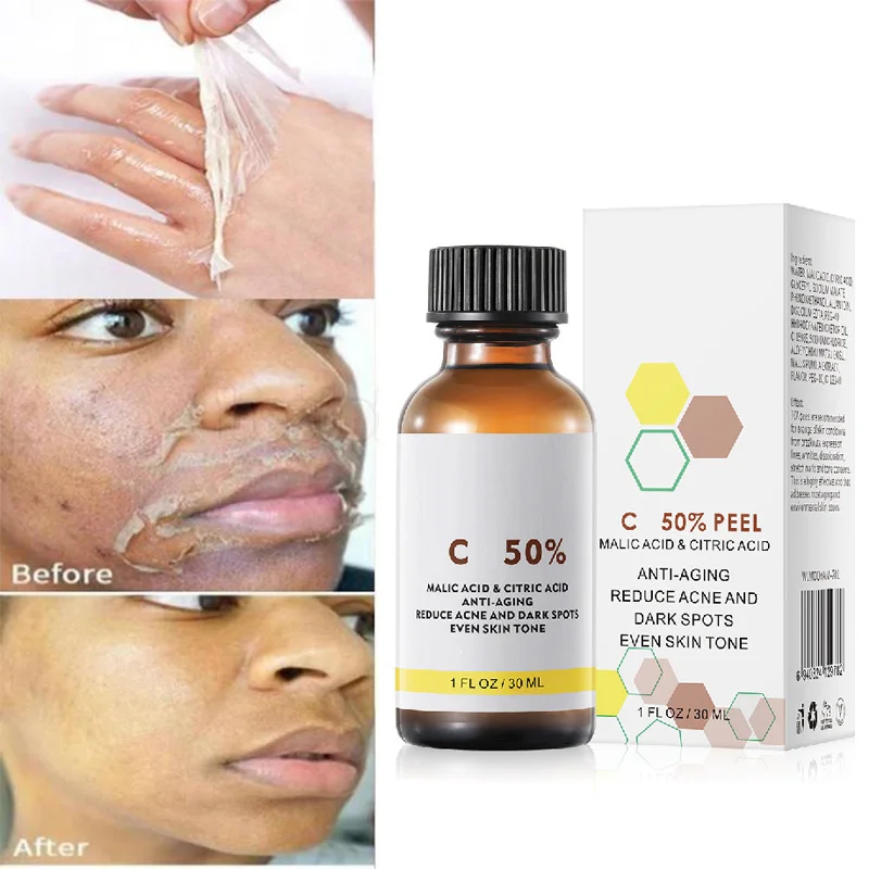 Tca Peel Serum Skin Rejuvenation Essence Removes Facial Cutin Deeply Cleanse Moisturizes Remove Acne Lightens Acne Mark Essence