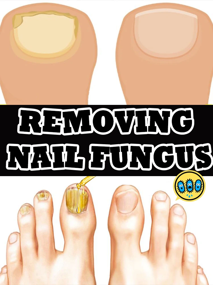 

Tea Tree Nail Treatment Solution, Daily Nail Care, Foot Care Tools