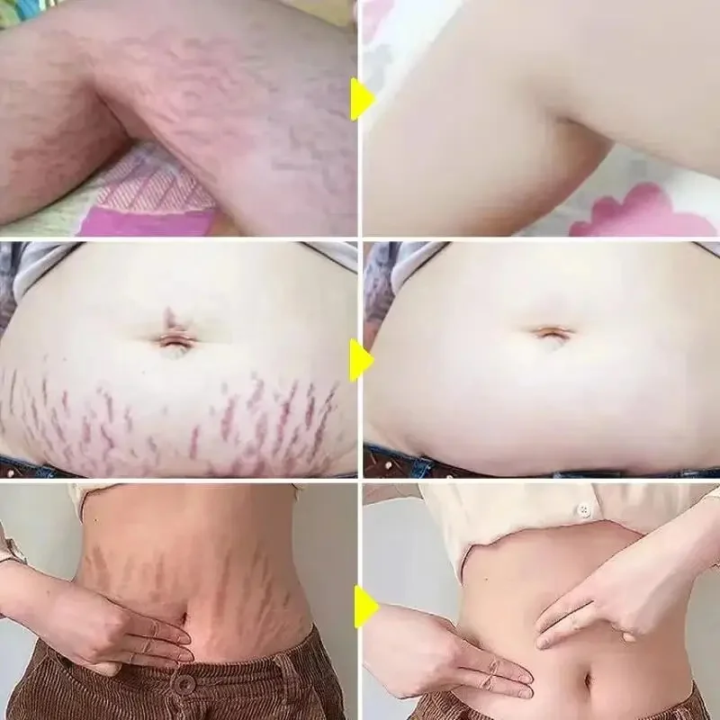 Krim penghilang Stretch mark, Anti kerut Anti Penuaan perawatan kulit kehamilan menghilangkan bekas luka kehamilan perawatan tubuh ketat