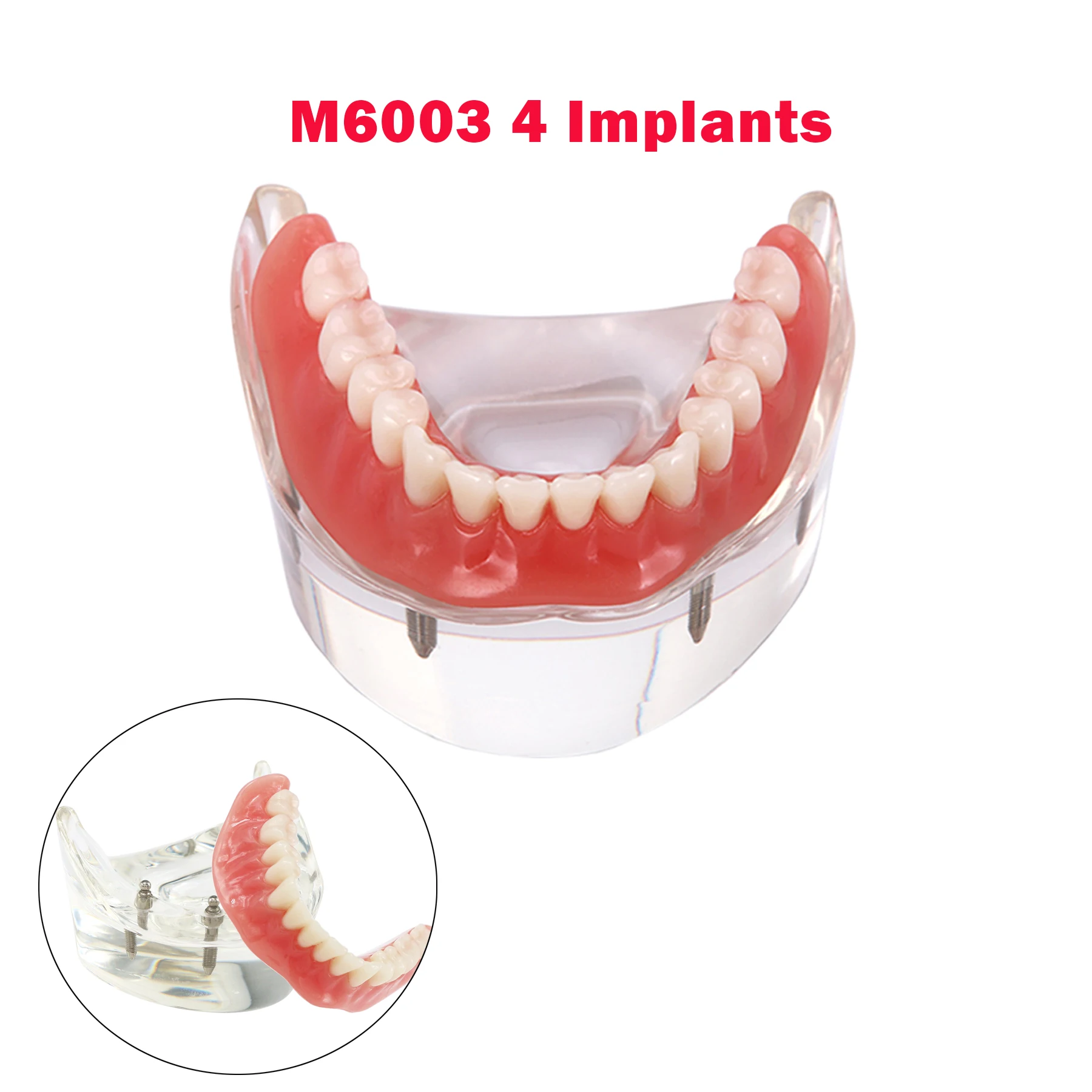 

Dental Teeth Model Implant Teeth Model 4 Implants Mandibular Explaining The Overdenture Functioning Teaching Demo M6003