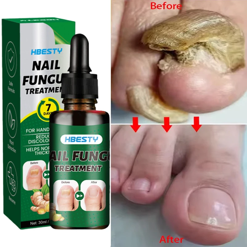 Nail Repairing Liquid Essence Hand Care Foot Fungal Removal Repair Serum Anti-infective Paronychia Nail Polish Repair Products