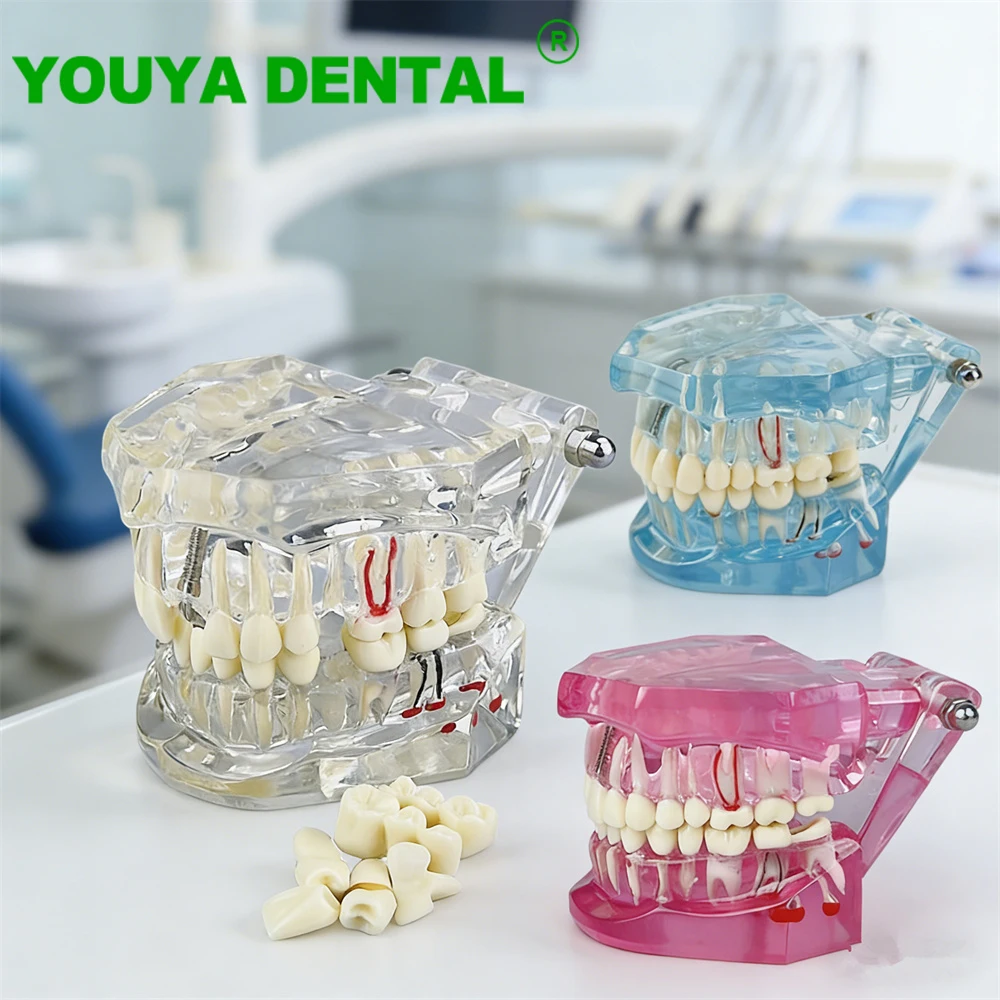 Teeth Repair Model Disease Dental Implant Restoration Bridge Study Model Dentist Demonstration Models For Patient Education