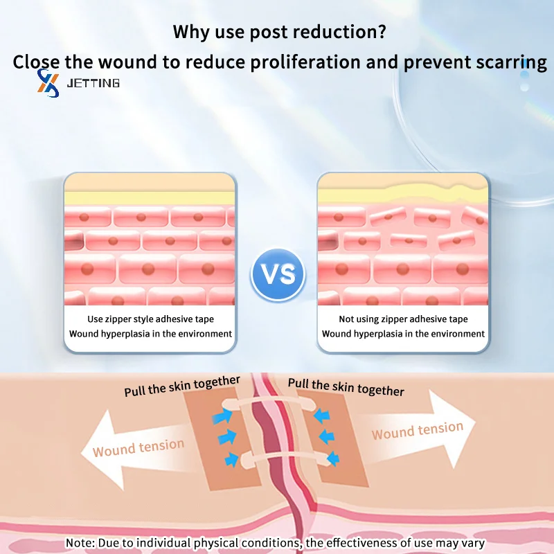 

2Pcs/box Zipper Tie Wound Closure Patch Elastic Strap Fast Suture Hemostatic Patch Skin Care Disinfect Band-Aid Outdoor Portable