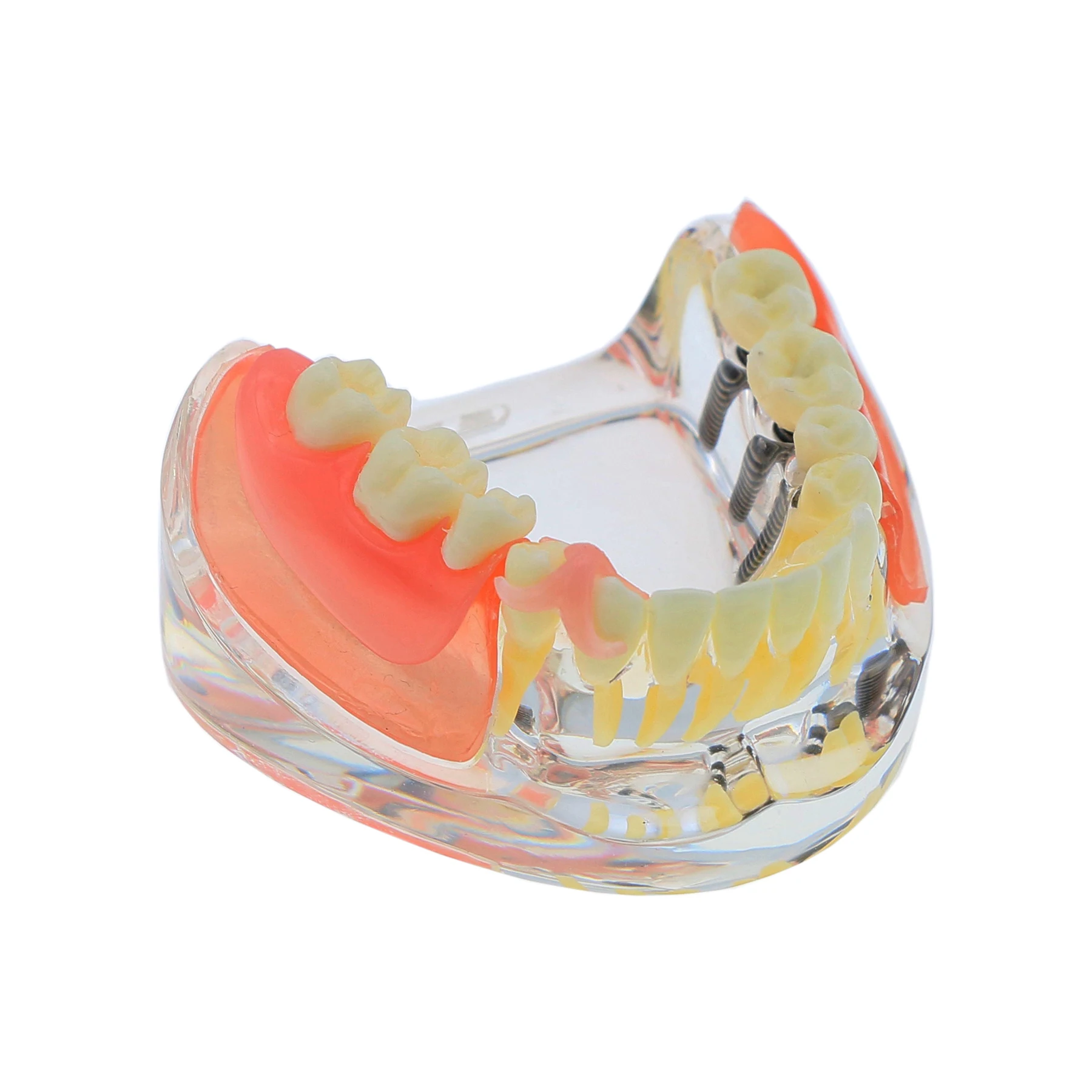 Teeth Model With 3 Lower Jaw Implants Removable Bridge For Dentist Communication Patient Demo Dental Teaching Model