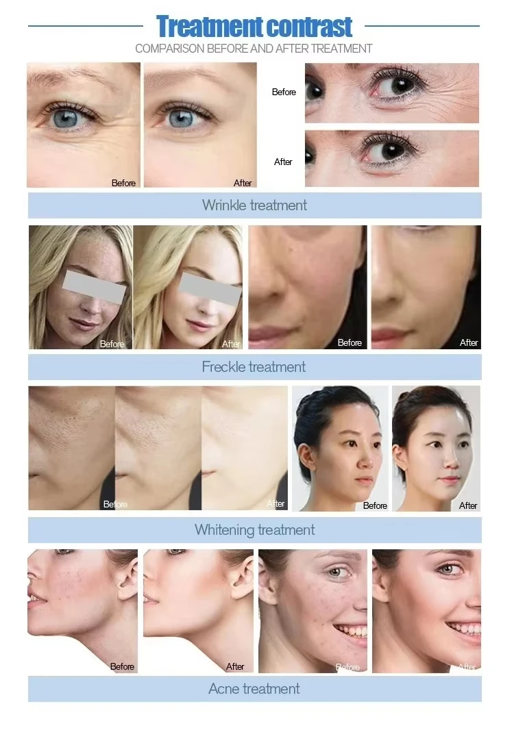 Jet Peel Moisturizing Spray Hydrating Facial Oxygen 1Water Jetpeel Equipment Non-invasive Mesotherapy Injection Jet Peel Machine