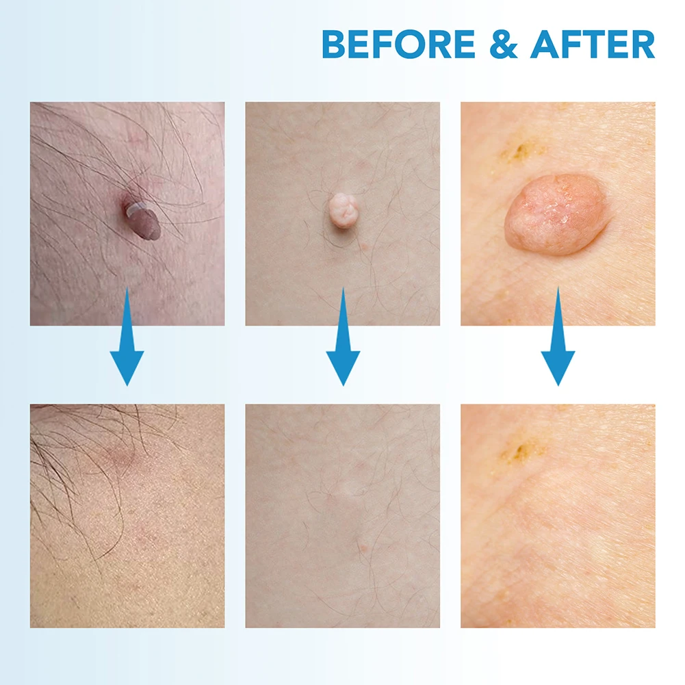 2-IN-1 السيارات الجلد علامة أداة إزالة الصواميل عدة غير مؤلم الجلد التسمية الخلد حب الشباب ثؤلول إزالة القلم مع مسحات التطهير أدوات العناية ببشرة الوجه #4