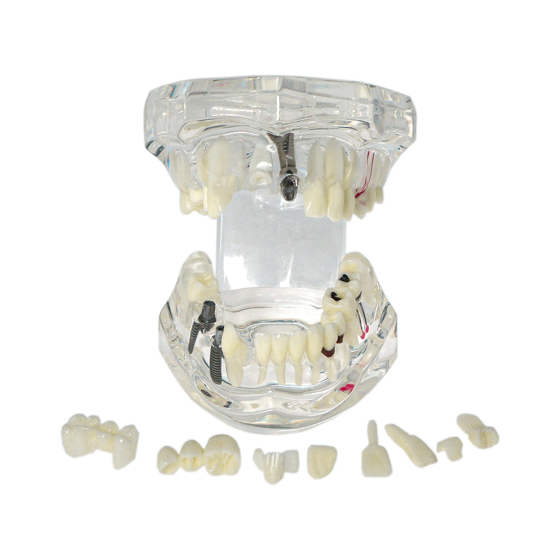 Dental Oral Typodont Model Implant Pathological Removable Teach Visible Anatomy and Restoration Model