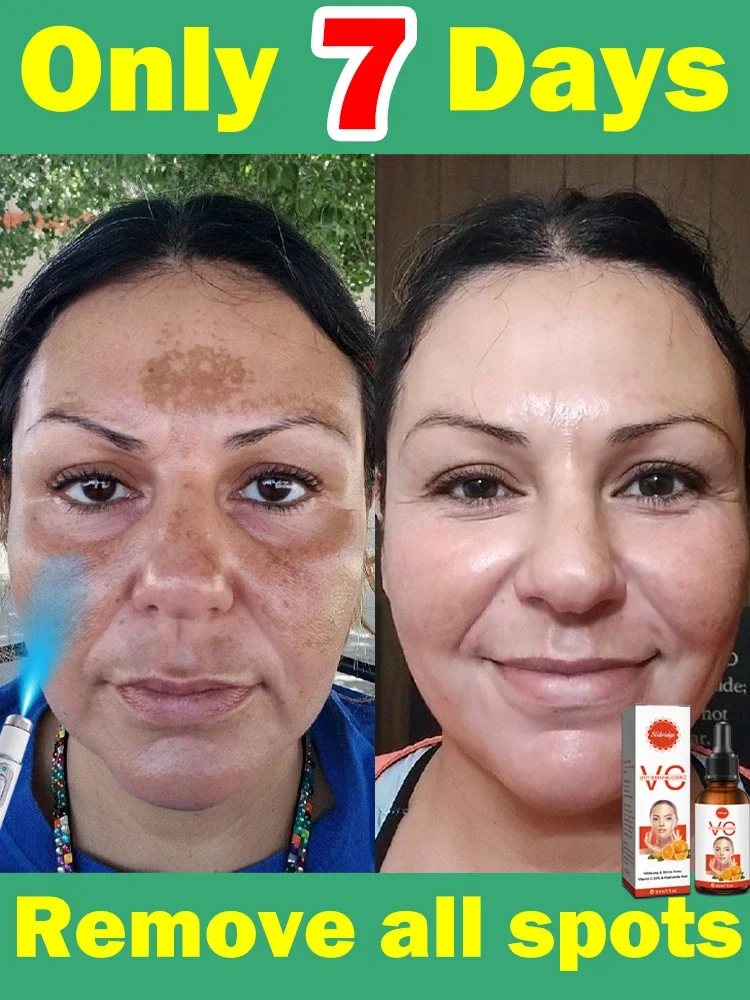 Manchas faciales desaparecen