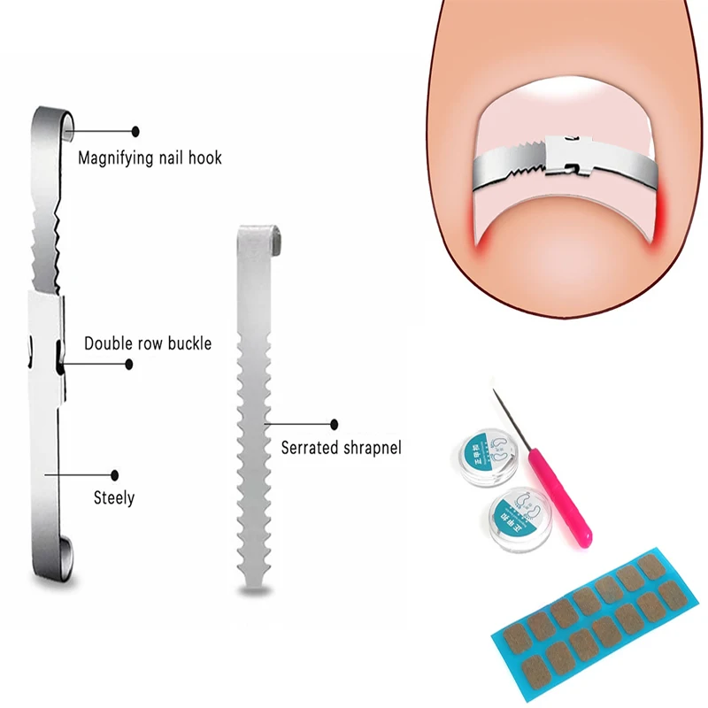 1 zestaw narzędzia do korekcji wrastających paznokci Pedicure odzyskaj osadzony paznokieć u nogi profesjonalna pielęgnacja stóp narzędzie do korekcji pielęgnacja stóp