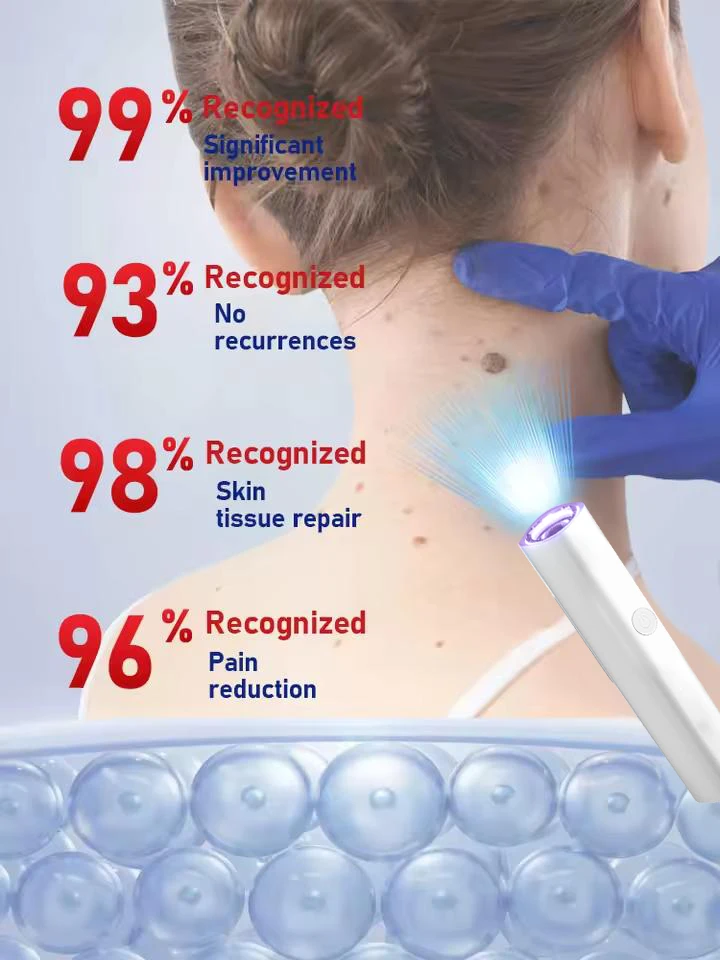 

новый Outil Wart Blue Light, а также изысканные уборы sur Les