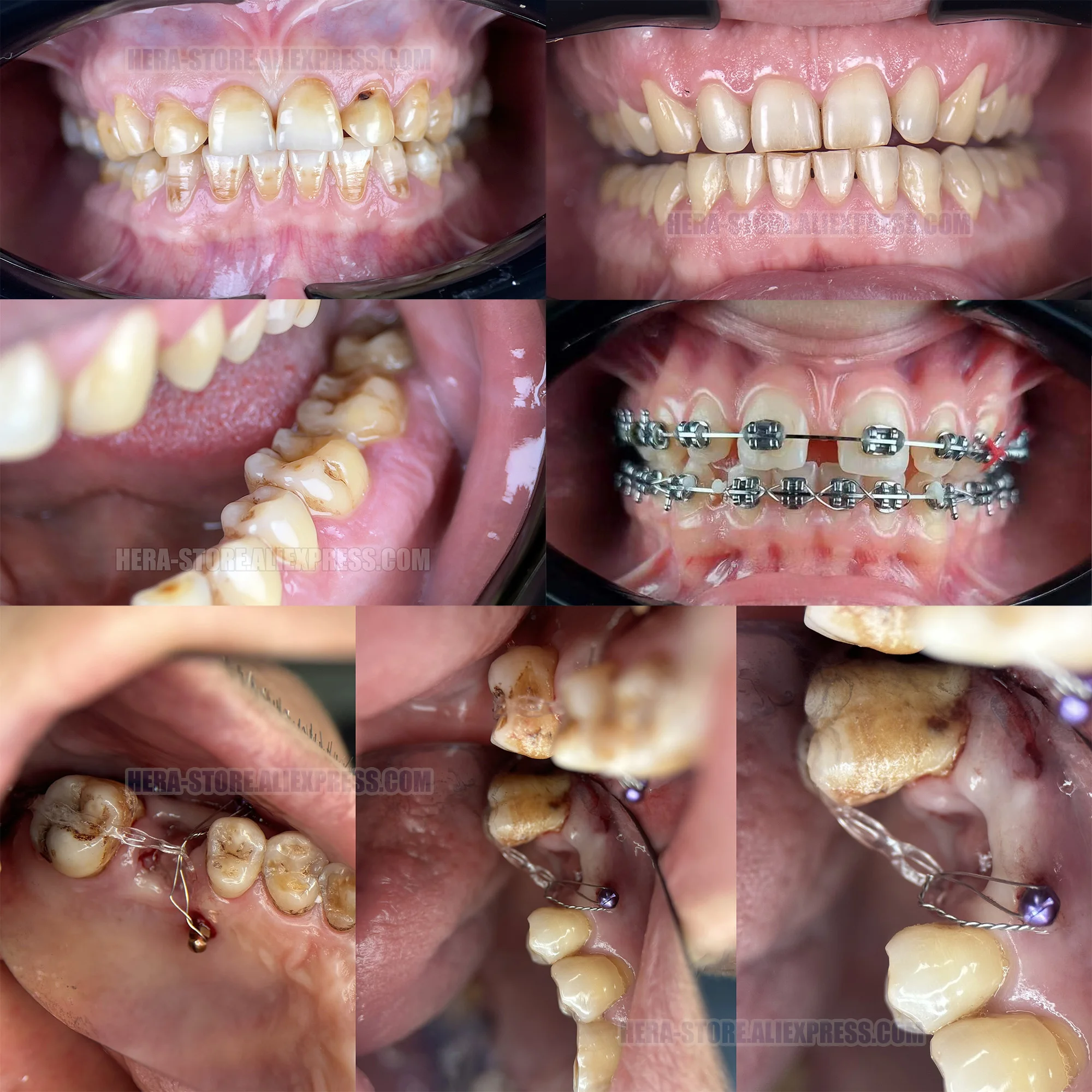 Światło LED do zdjęć dentystycznych. Światło do fotografii dentystycznej. Makro, polaryzator, wewnątrzustny, zdjęcie protez z lampką telefoniczną