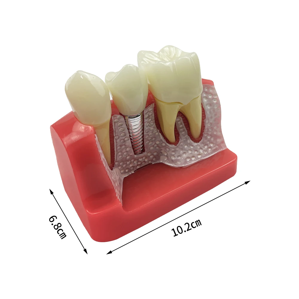 Dental 4 Times Implant Teeth model Analysis Crown Bridge Demonstration Removable Model Dentist Patient Demonstration Model