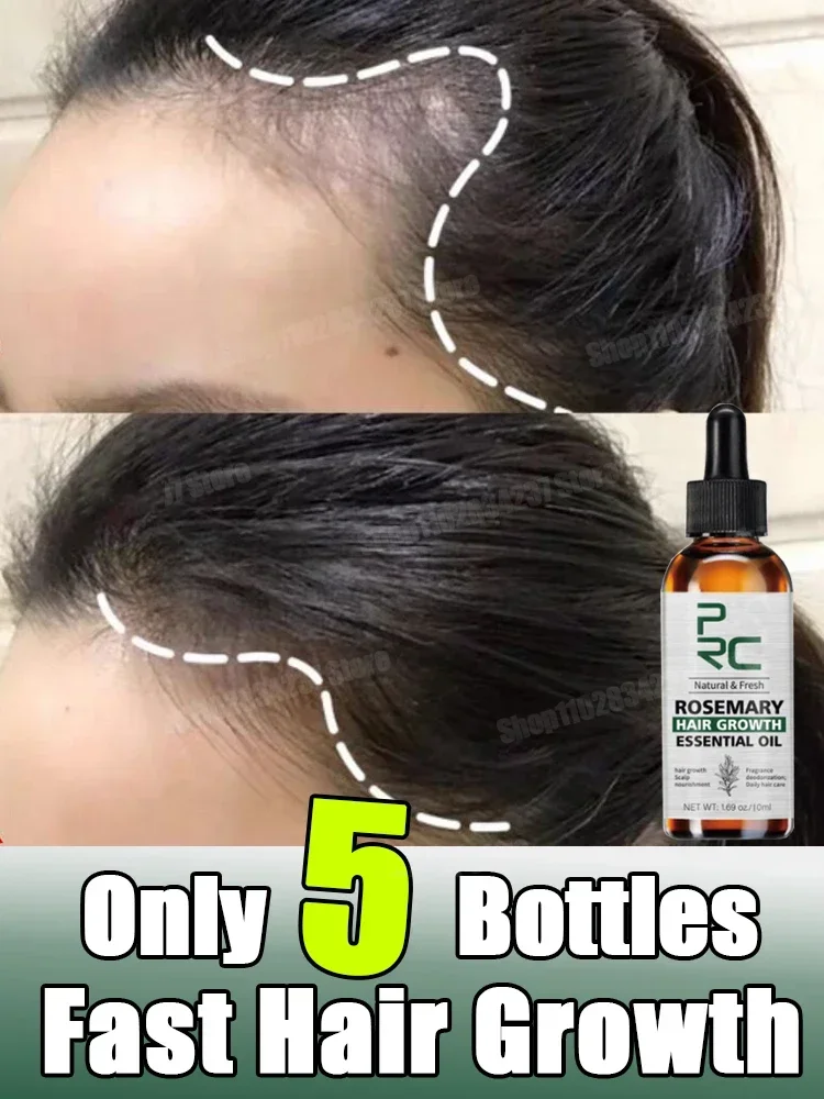 

Fast Hair Growth Essential Oil Promoter Hair Loss Hereditary Seborrheic Alopecia for Hair Growth 3