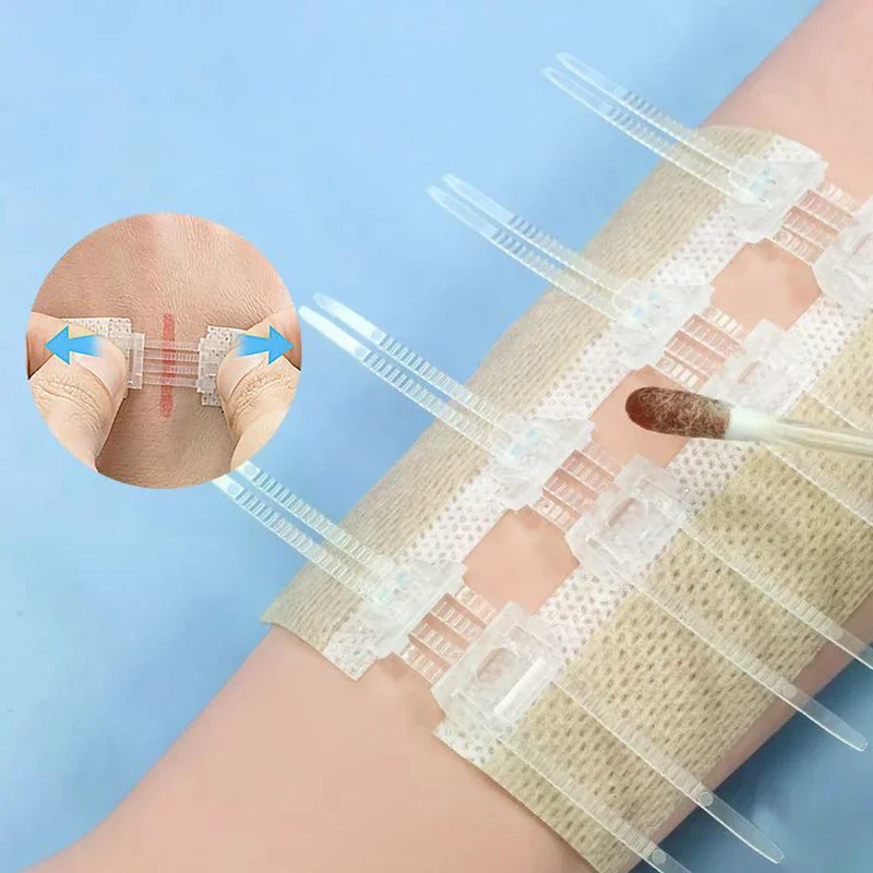 

Portable Zipper Tie Wound Closure Patch Hemostatic Patch Wound Fast Without Suture Zipper Outdoor Band-Aid Quick Clot Wound