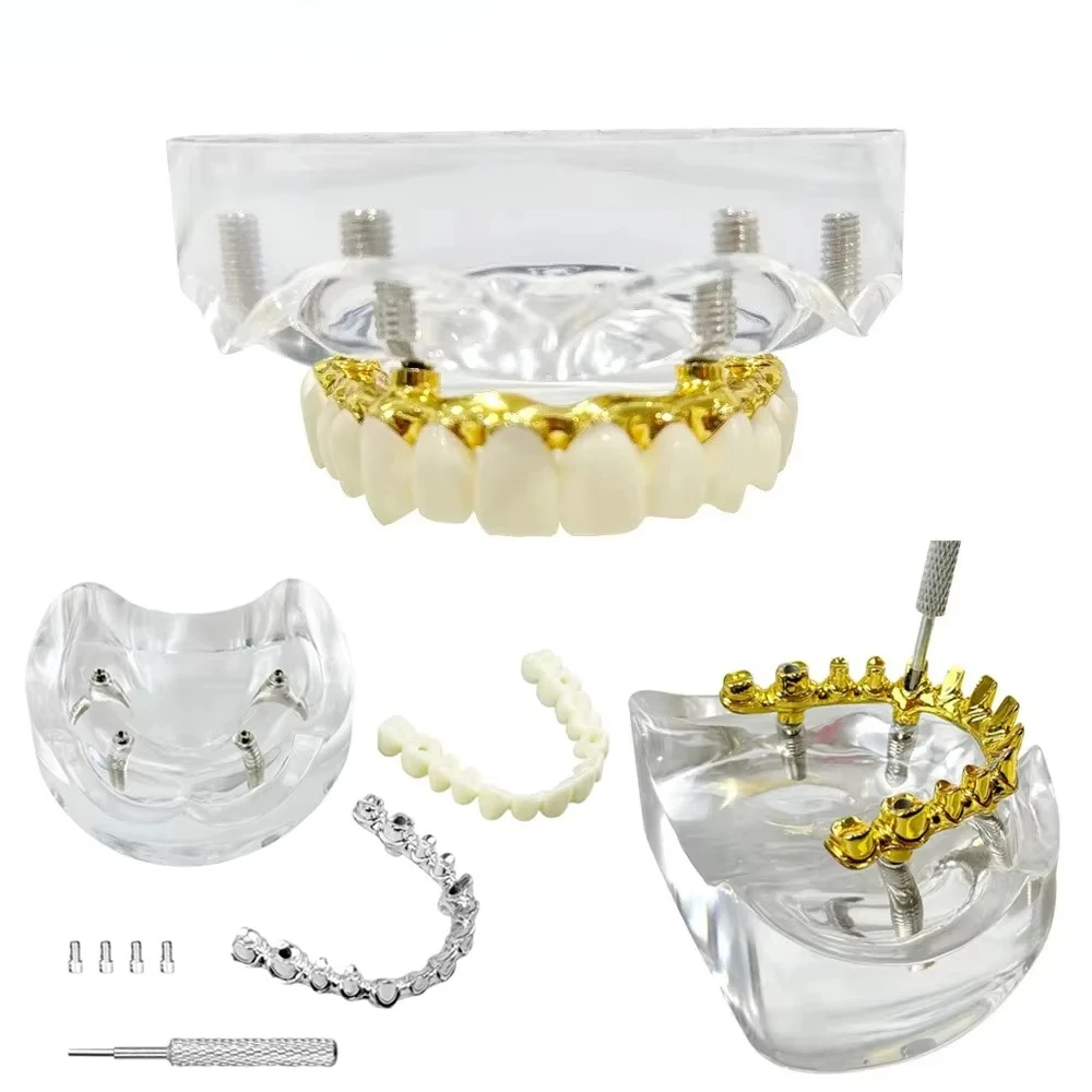 Dental Implant Model With Restoration 4 Implants Upper Jaw Removable Teeth Model Overdenture For Dentisit Teaching Demonstration