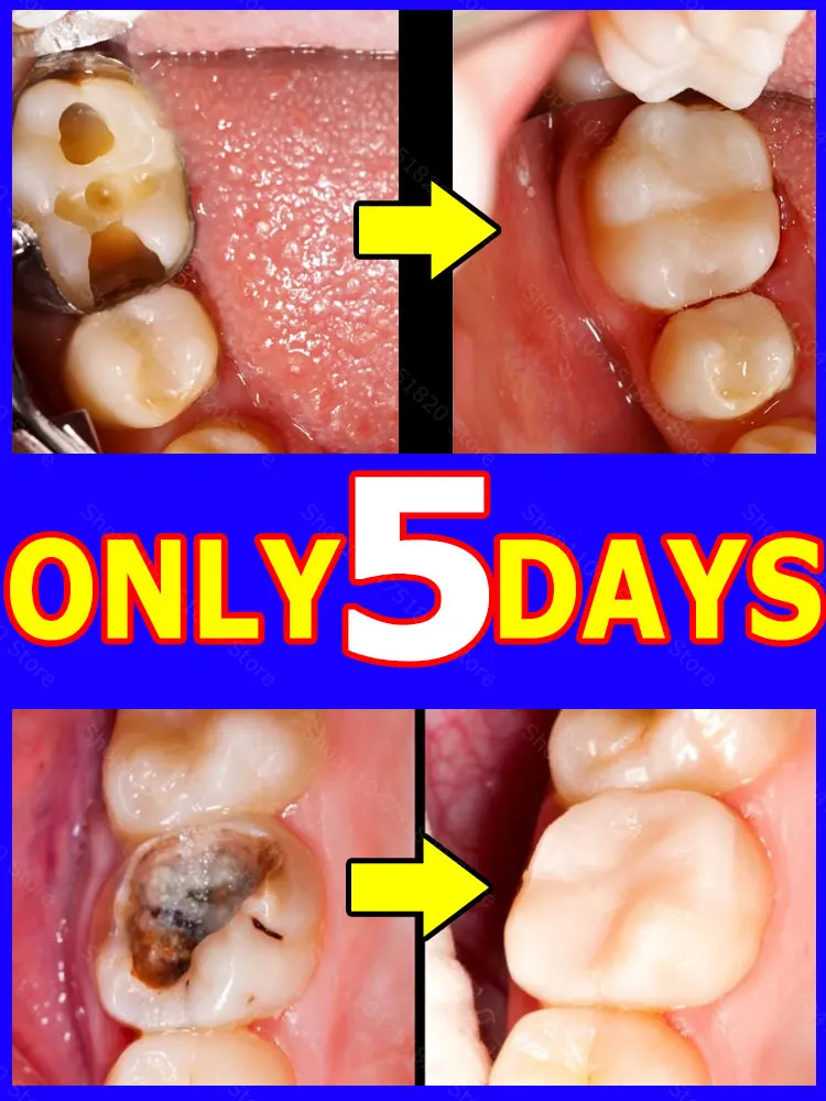 

Contains probiotics to repair tooth decay and clean teeth