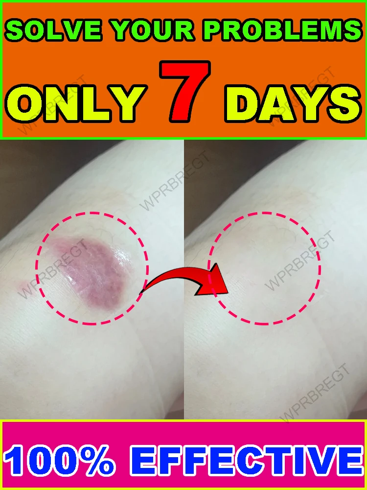 Bespaar huiduitdaging, vlekken verdwijnen!