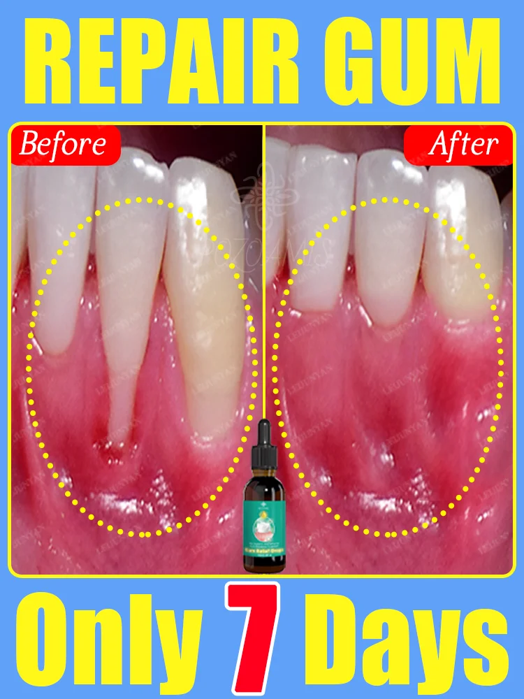

Hot-selling gum drops, get rid of damaged gums, relieve gum pain, strengthen teeth, and make gums healthy! ! ! ! !