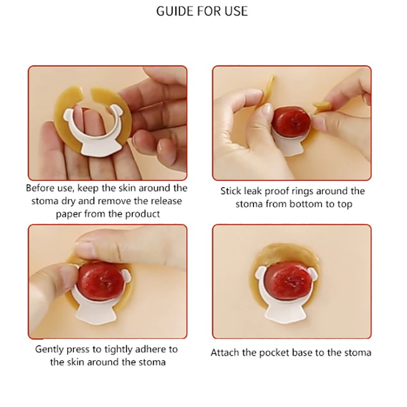 10pcs Ostomy Bag Leakproof Ring Soft Glue Baseplate Anorectal Stoma Protection Fistulation Health Care Directional Guide Vane