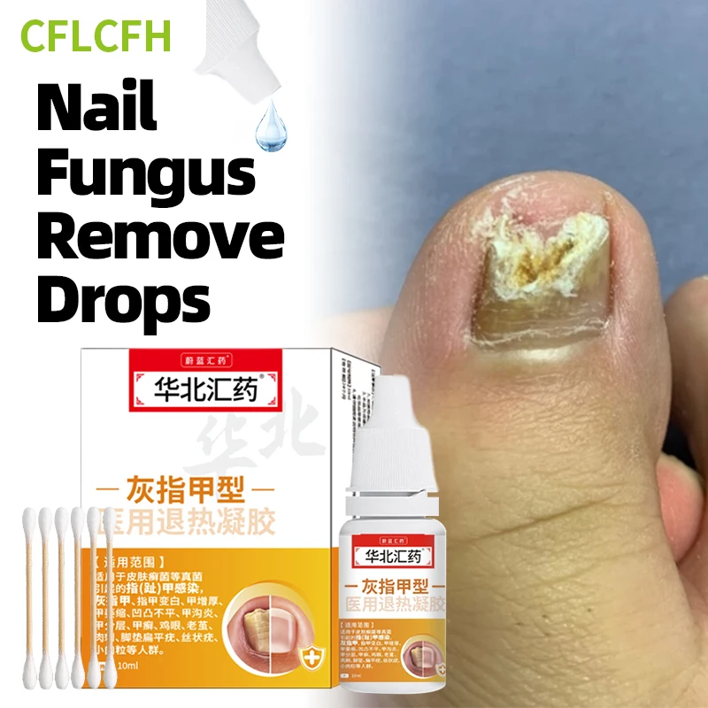 

Fungal Nail Treatment Oil Onychomycosis Paronychia Feet Nails Fungus Repair Care Essence Anti Infection Essence 10ml