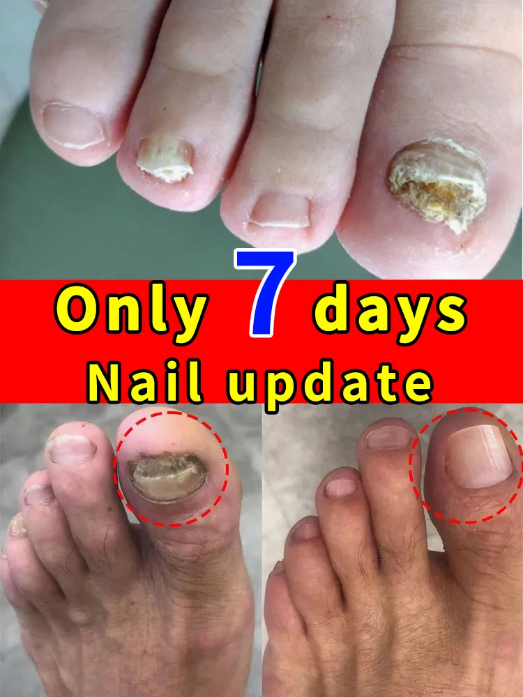 Are you still worried about your nail health?