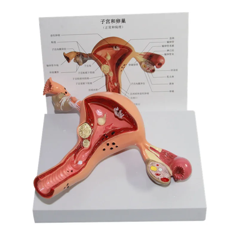 

Anatomy Human Pathological Uterus Ovary Medical Model Anatomical Disease Pathology Lesion For Teaching
