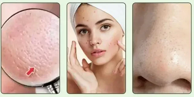 Xylitol Oil Control Emulsion Lotion Oilly face Control Moisturizing Water Replenishing Refreshing Anti-aging 500grams - view 4