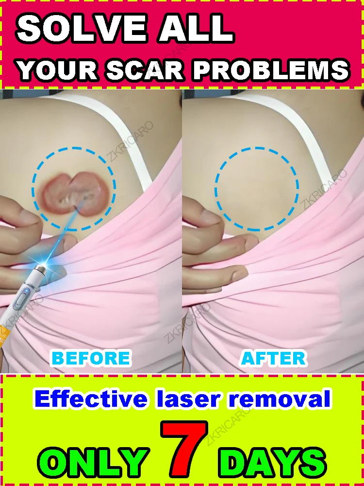 

Upgraded laser, suitable for all types of scars