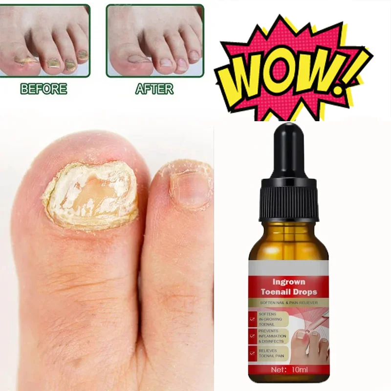 

Nail Repair Solution Contains Anti-Infective Formula To Remove Nail Fungus