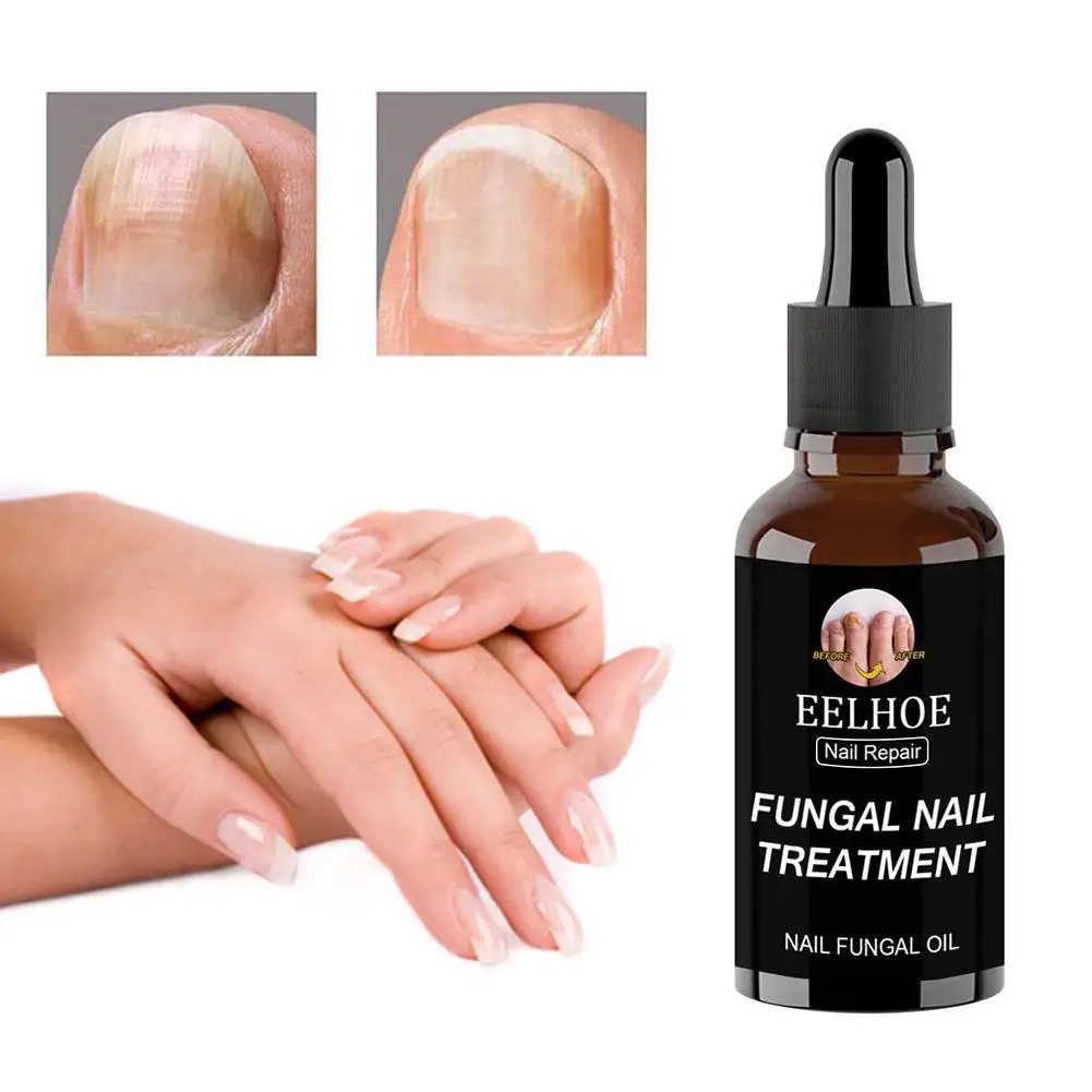 30ML Nail Fungus Treatment piedi Care Essence Nail Foot Repair Toe Nail Gel per la rimozione dei funghi Anti infezione Paronychia