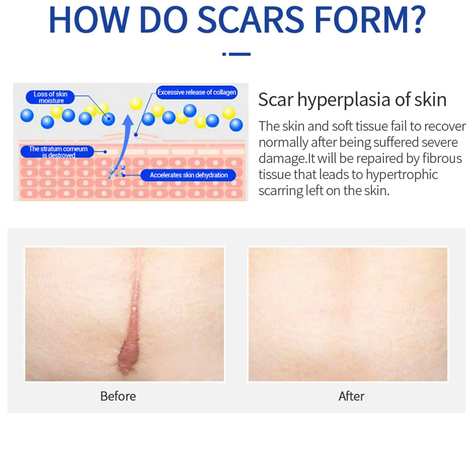 20g Scar Removing Cream Hyperplasia Scar Repairing Gel Remove Acne Spots Treatment Smoothing Whitening Skin Beauty