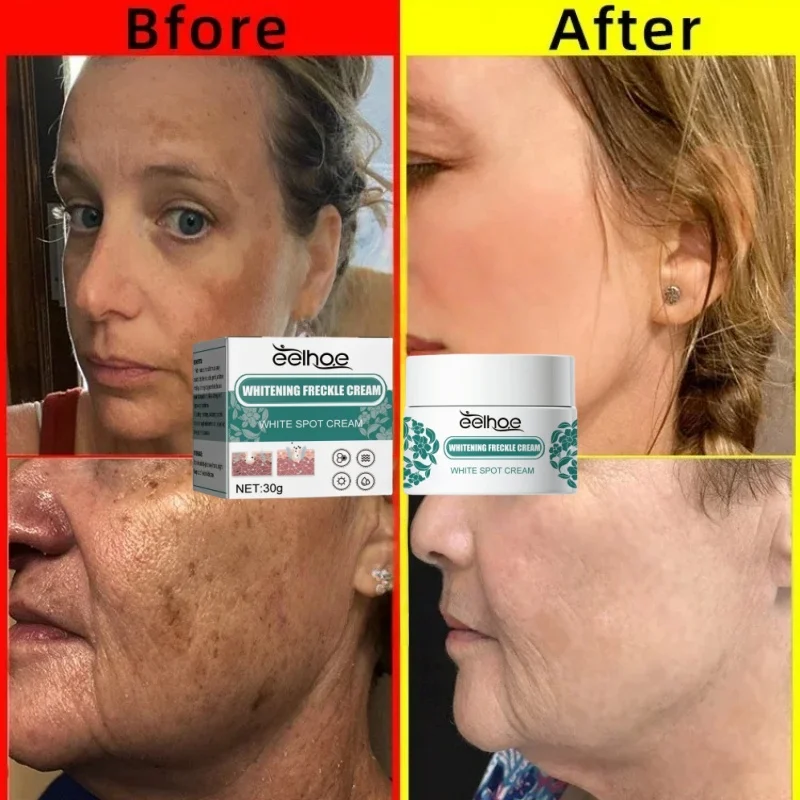 

Removal Dark Spots Whitening Freckle Cream Leaving skin looking brighter clearer and more luminous prevent future discoloration