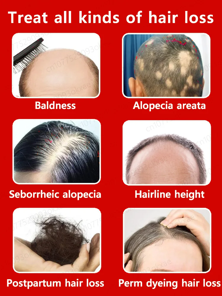 Aceite esencial para el crecimiento del cabello Repara eficazmente los síntomas de la calvicie y la caída del cabello caída del cabello hereditaria productos naturales para el crecimi