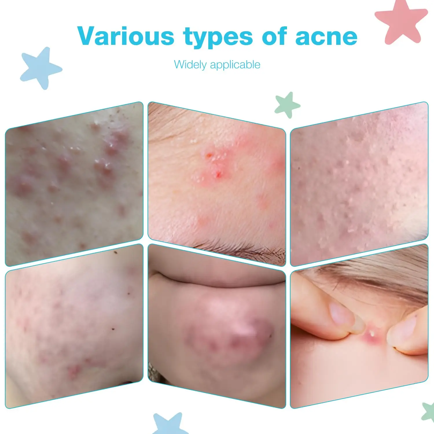 284 قطعة من ملصقات البقع اللطيفة (النجمة/القمر/القط) - رقع البثور غير الطبية، للاستخدام النهاري والليلي، صديقة للبشرة للعناية اليومية بالبشرة