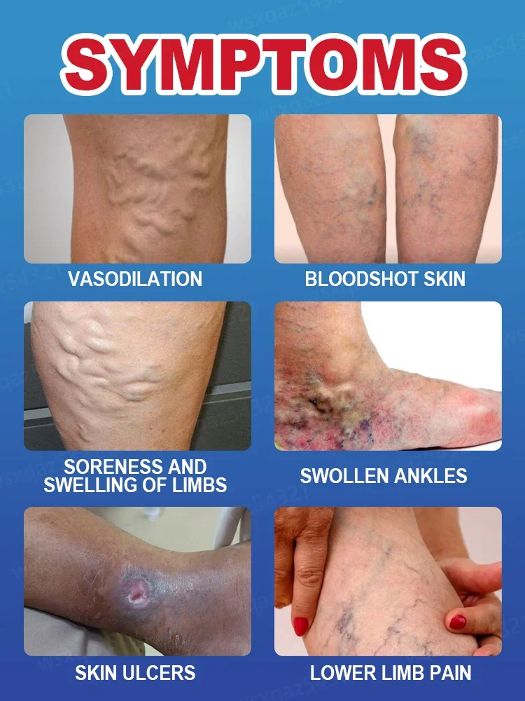 Laser therapy can improve medium-intensity varicose veins, effectively unblock and permanently eradicate them