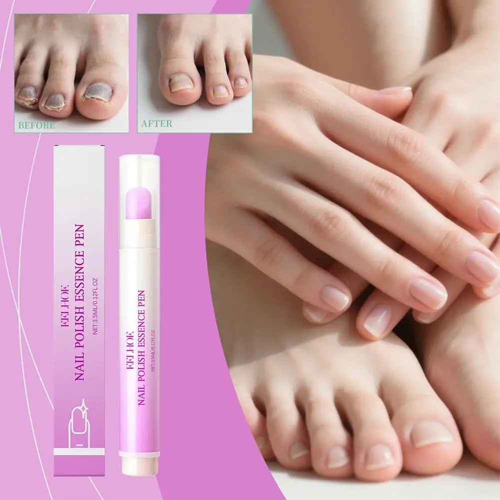قلم إصلاح عدوى الأظافر مضاد فطار الداحس الأصفر تحسين إزالة الأظافر تغير لون القلم العناية أظافر القدم متعة C2C7