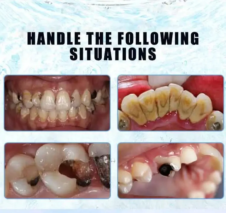 Reparación de cavidades y Caries, eliminación de manchas de placa, blanqueamiento, reparación de amarillos, blanqueamiento de dientes, pasta de dientes, nuevo 2023