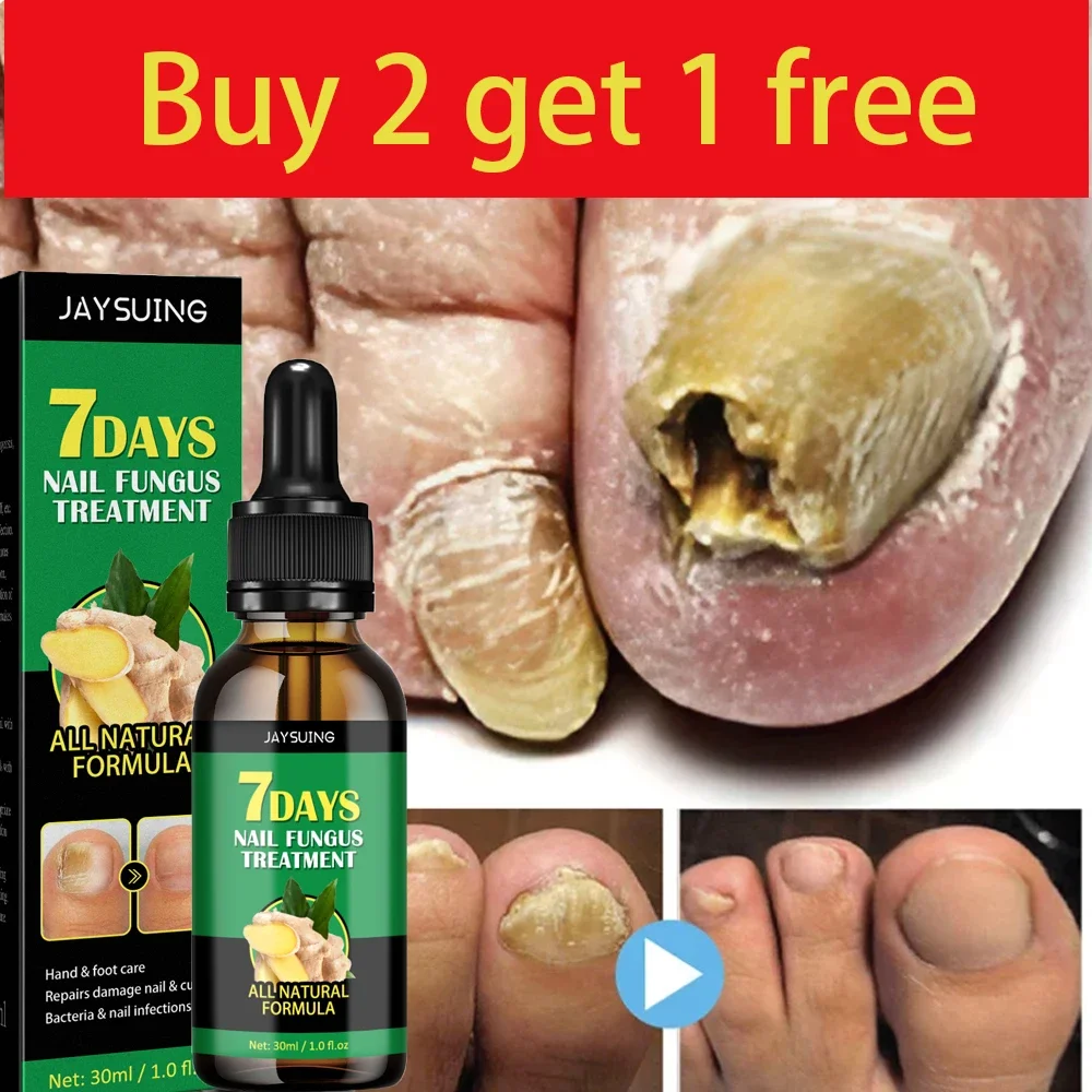 

Nail Fungal Treatment Serum 7 Day Foot Toe Nail Fungus Removal Essential Oil Anti Infection Onychomycosis Repair Care Products