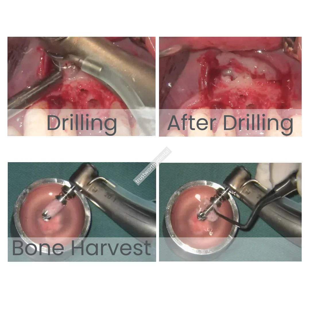 Taladro de resorte para cosecha de huesos Dental φ2.8, fresas de Trephine, taladro de recolección de polvo de hueso autogénico