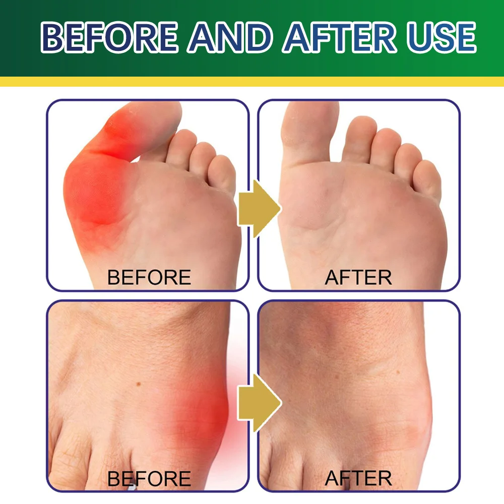 8pcs Herbal Bunion Joint Patch Effectively Relieve Fatigue Soreness Stickers for Body Health Treatment