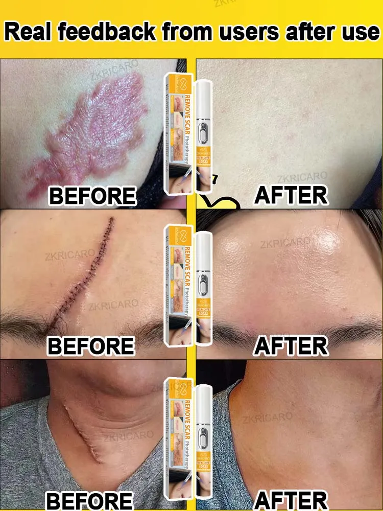 เลเซอร์พิเศษเพื่อความงามของรอยแผลเป็น |   ปากกาเลเซอร์แผลเป็น |   เหมาะสําหรับรอยแผลเป็นทุกชนิด