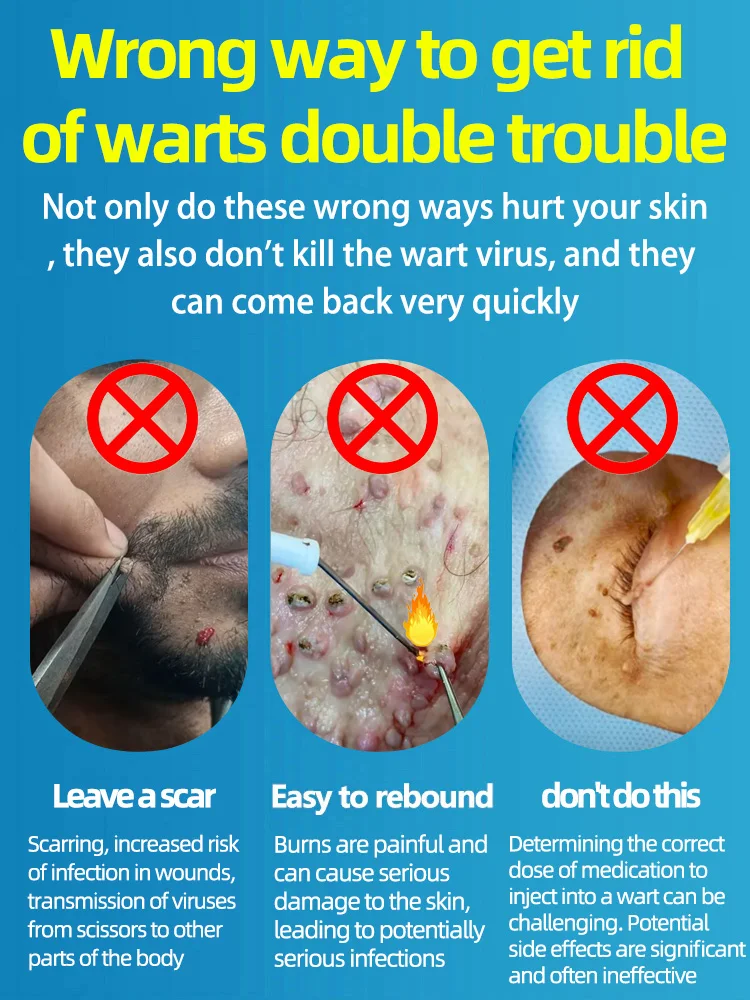 Warts-Removal