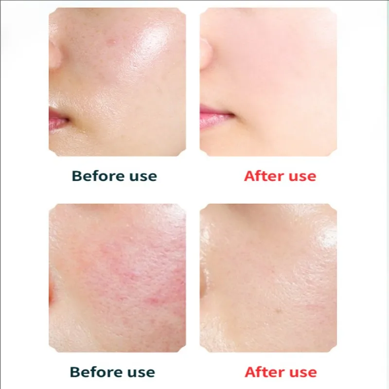 Elettrico 4 In1 Silicone Comedone Esfoliante Pelle Rafforzamento Massaggio Home Spa Detergente per il viso Cura Pulizia Spazzola per il viso Detergente