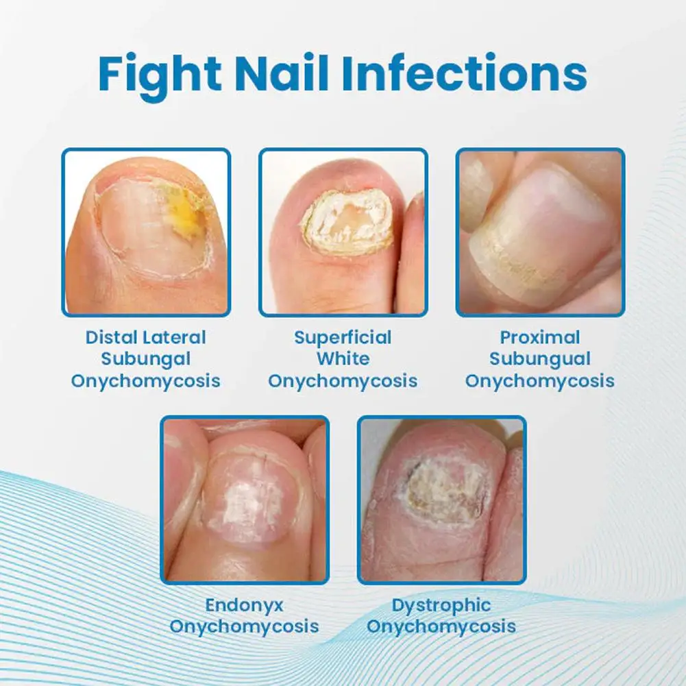 Stylo liquide de réparation des ongles avec brosse, dissolvant antifongique doux, onychomycose, paronychampignon des ongles FriendFoot, N64.Manucure O7x3